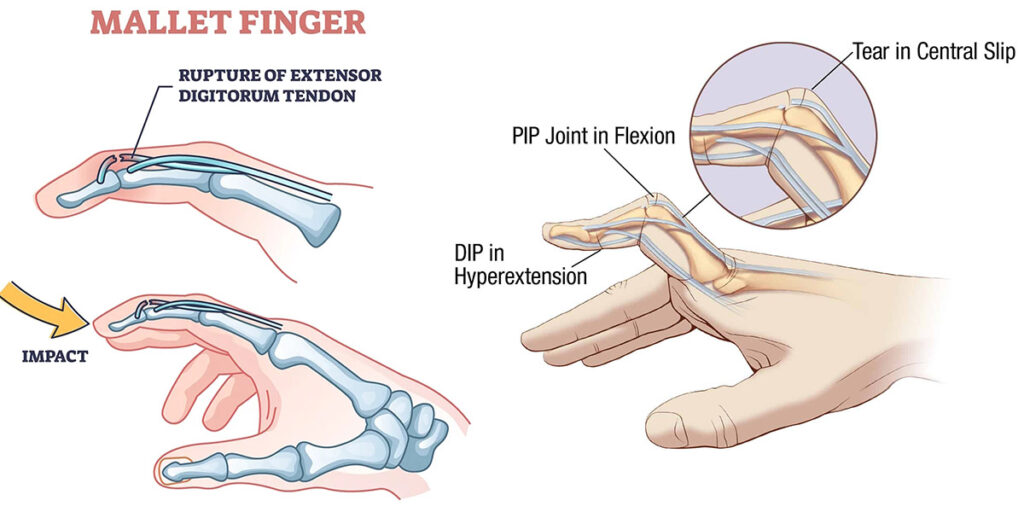 Hammerfinger und eingeklemmter Finger