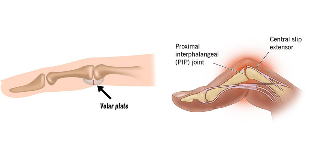 Lésions de la plaque palmaire et blessures du tendon extenseur central