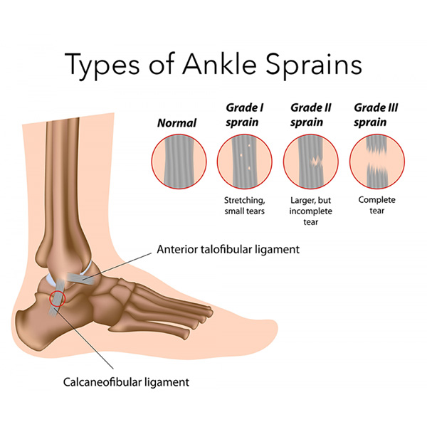 ankle-sprains