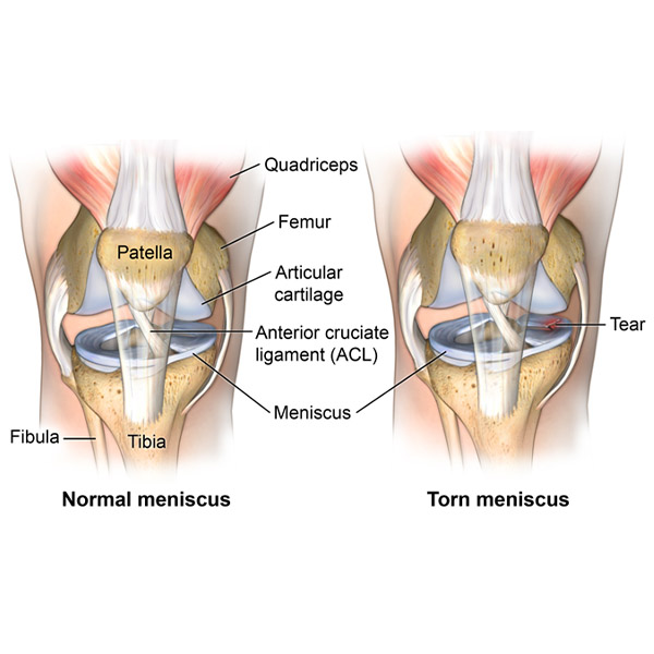 Knee meniscus injury