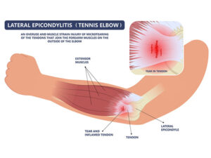 Kinesiology Tape For Tennis Elbow | Why and How to Use It