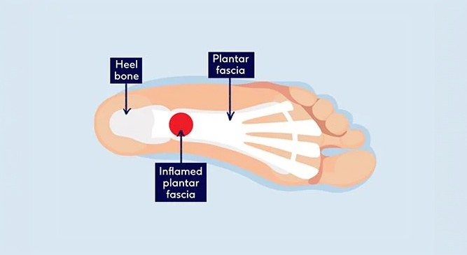 fascitis plantar