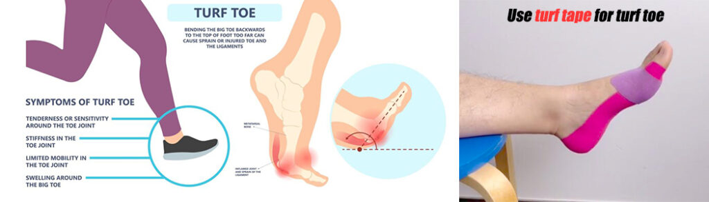 kinesiology tape for turf toe